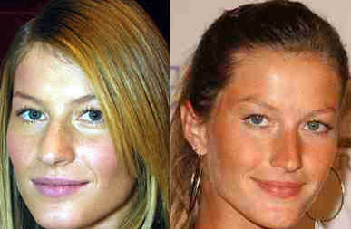Giselle Bundchen: Rinoplastica