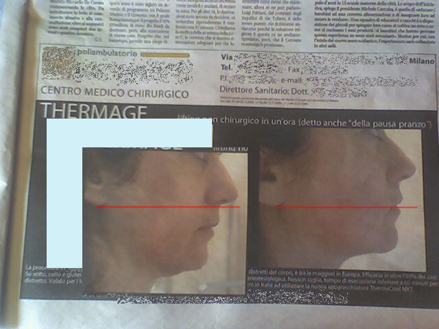 Foto pubblicità thermage 3