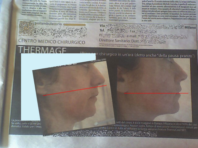 Foto pubblicità thermage 4