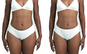 elaborazione liposcultura