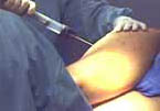 Liposcultura