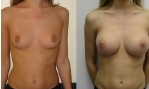 Mastoplastica additiva foto prima e dopo