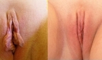 Riduzione delle piccole labbra, galleria foto pre e post operatorie